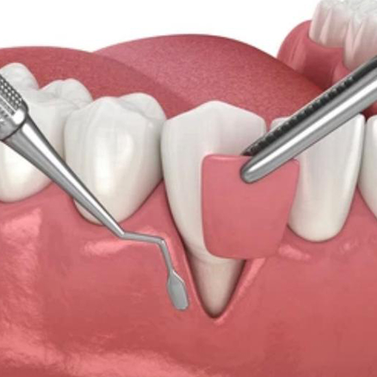 Gum Dentistry