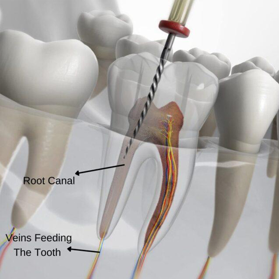 Root canal